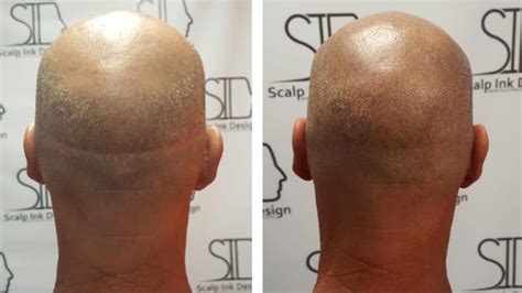 colmek+smp|Scalp Micropigmentation in Miami 